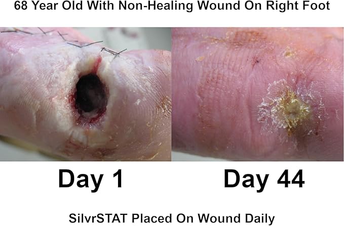 SilvrSTAT First Aid Kit Gel | 32 PPM Silver Healing Wound Dressing Solution | SilverSol Ag₄O₄ Particles | 3 oz